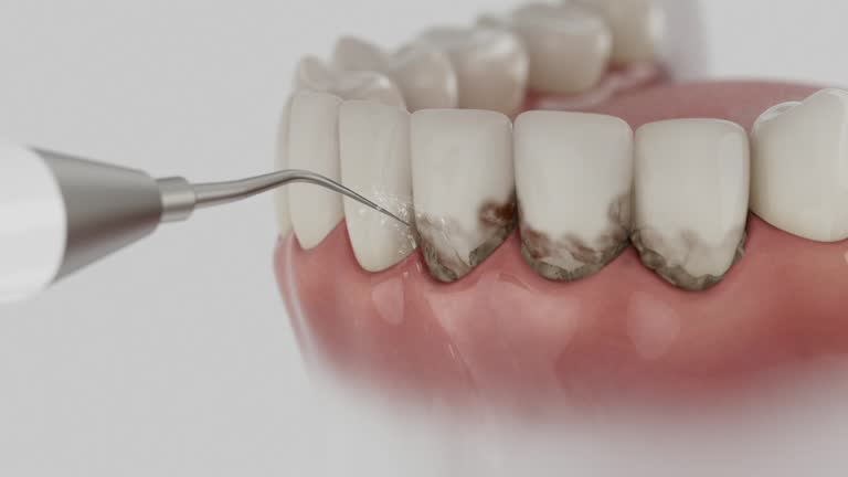 Reliable Dental Implants contractor in Clermont, IN by Smile Center Dentistry